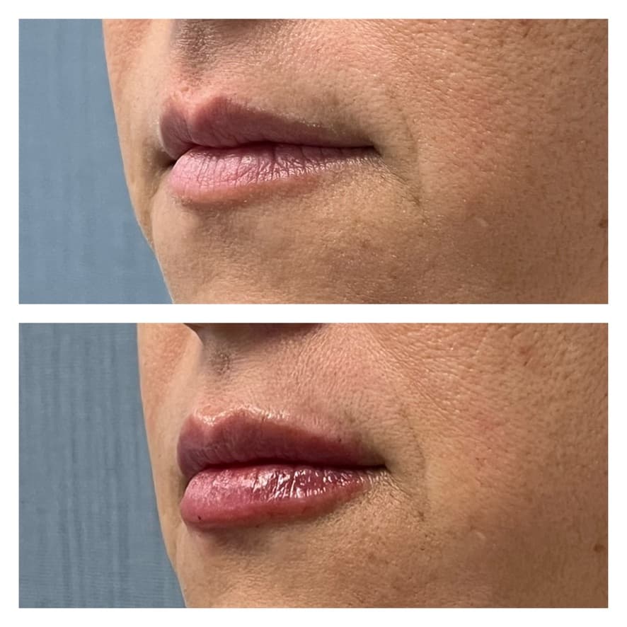 Ácido hialurónico en labios: antes y después