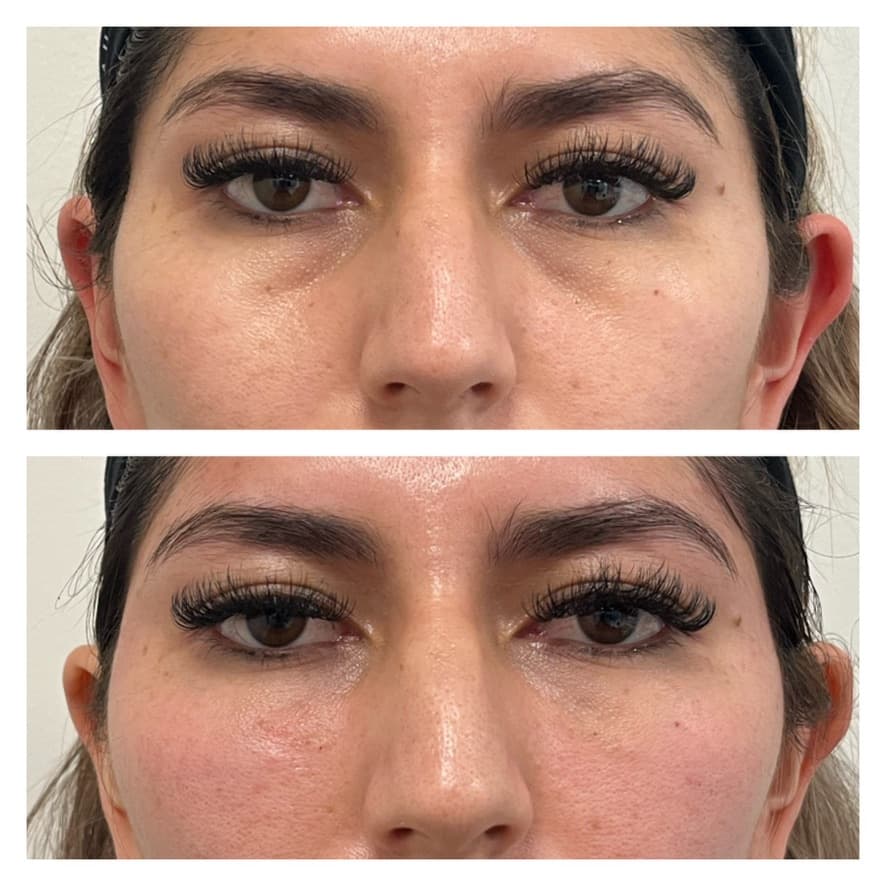 Ácido hialurónico en ojeras: antes y después