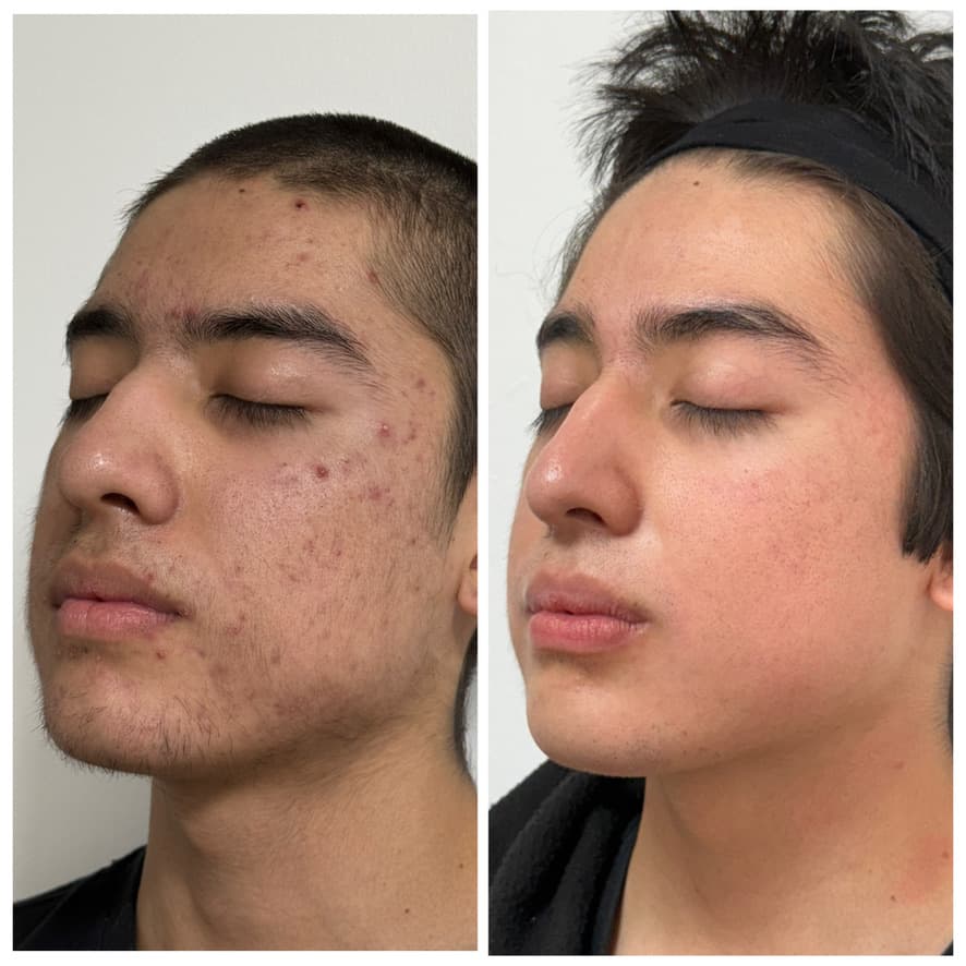 Tratamiento de acné: antes y después