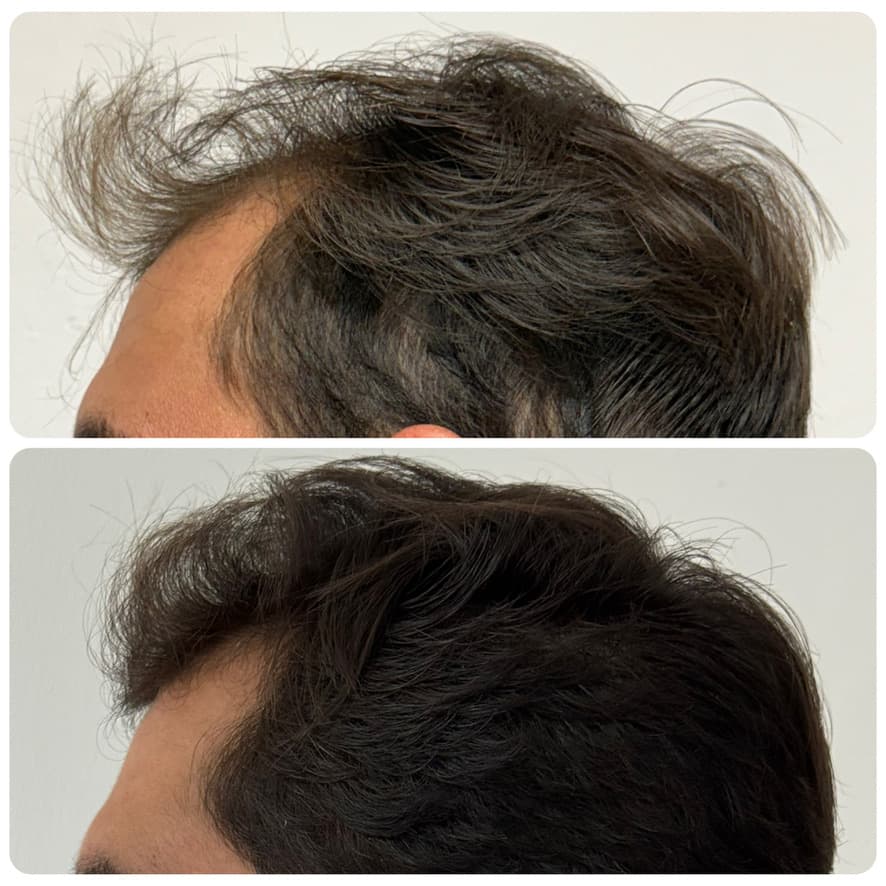 Tratamiento de alopecia: antes y después