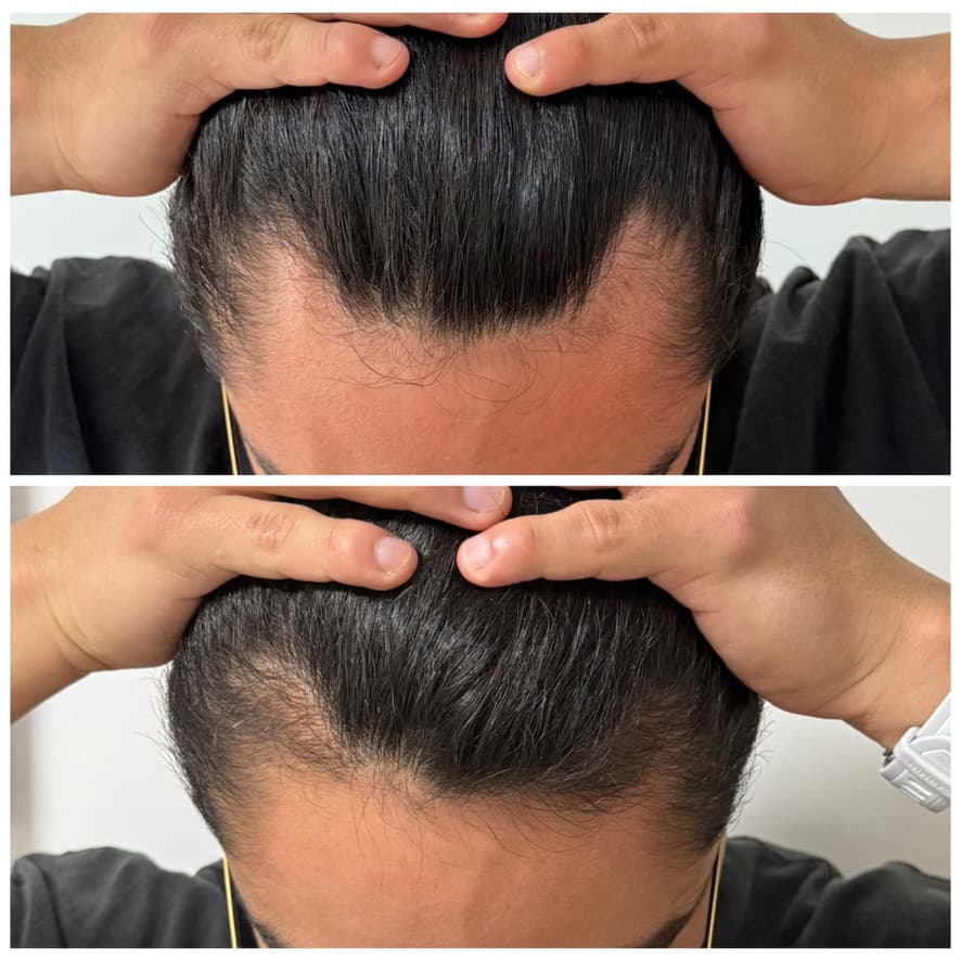 Tratamiento de alopecia: antes y después