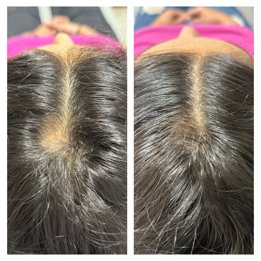 Tratamiento de alopecia: antes y después