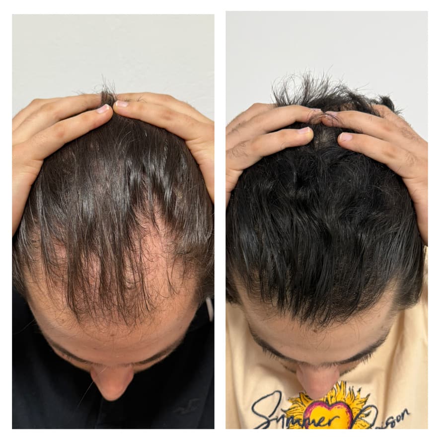 Tratamiento de alopecia: antes y después