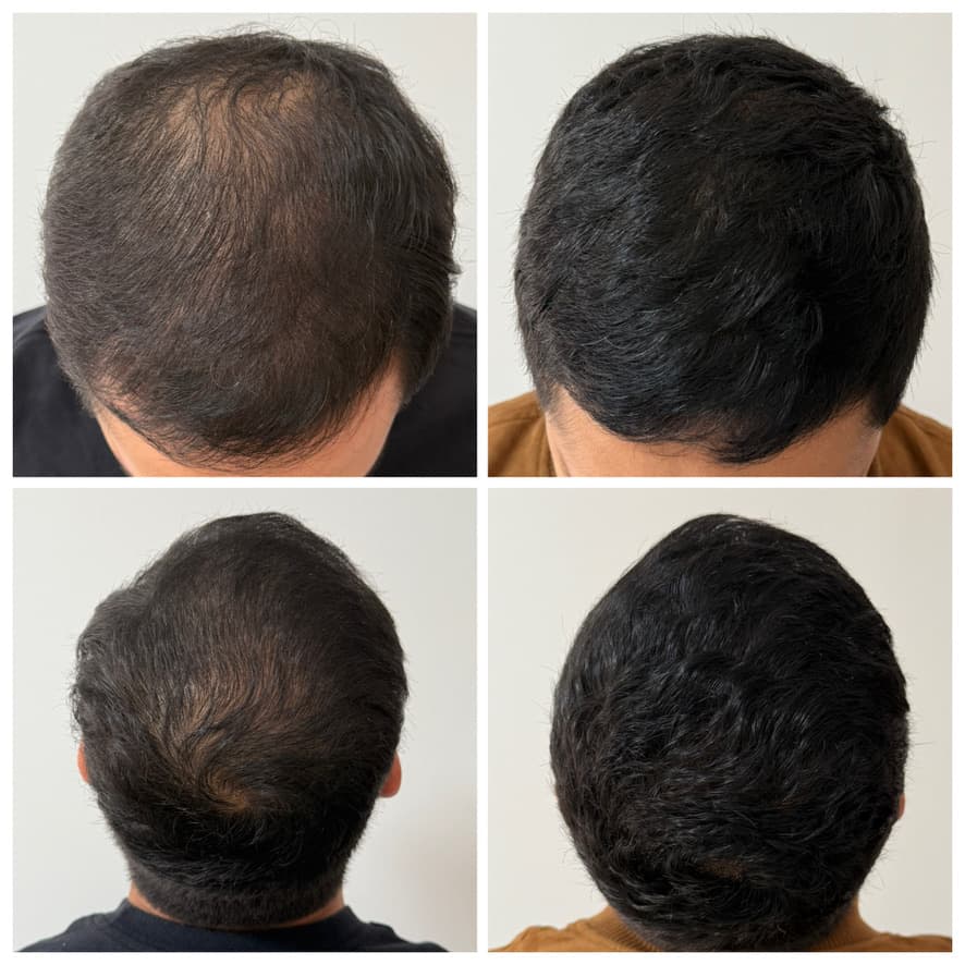 Tratamiento de alopecia: antes y después