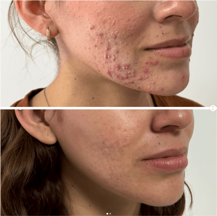 Acne treatment: before and after