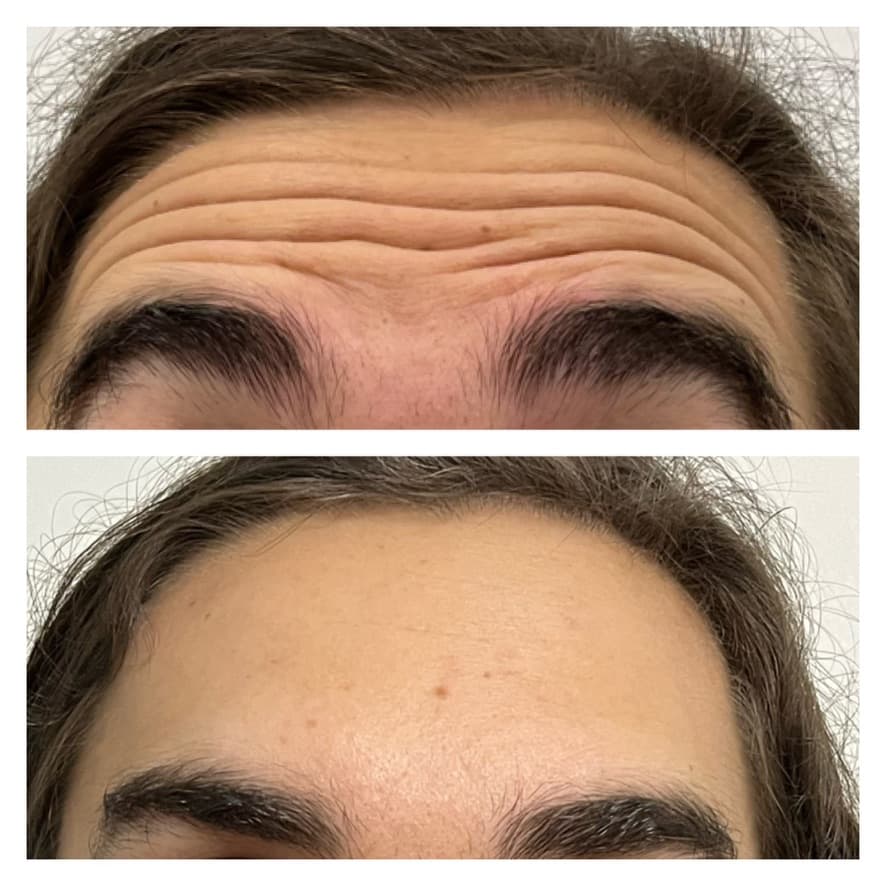 Toxina botulínica: antes y después