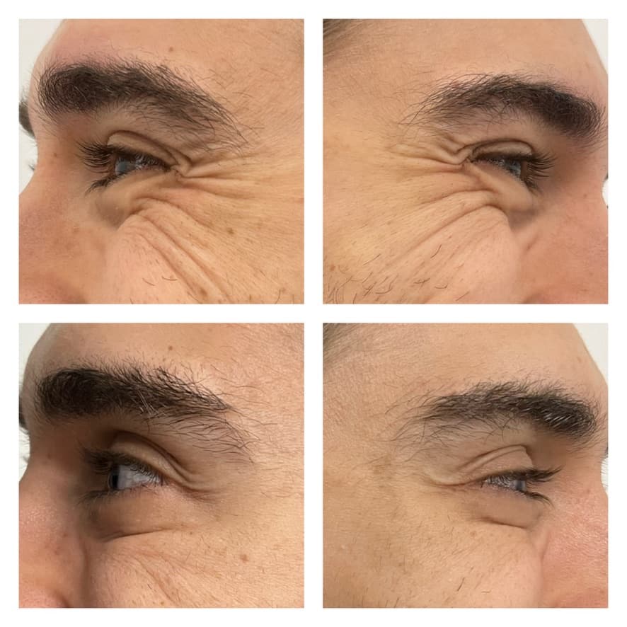 Toxina botulínica: antes y después