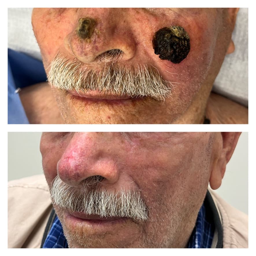 Corrección de cáncer de piel en nariz y mejilla: antes y después