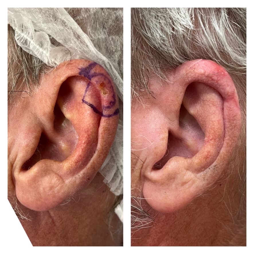 Extirpación de lesión en oreja: antes y después