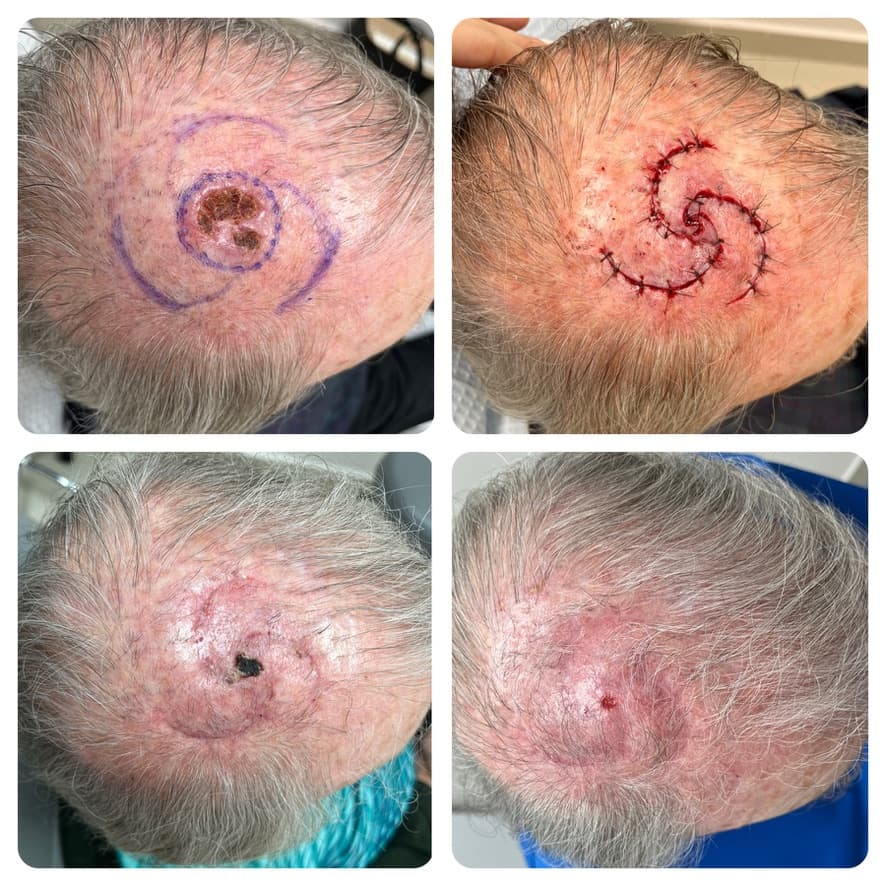 Cirugía de cáncer de piel en cuero cabelludo: antes y después