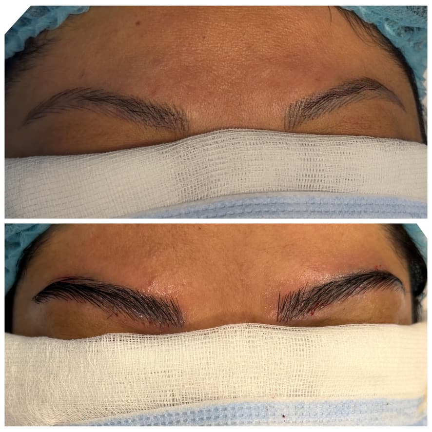 Injerto de cejas: antes y después