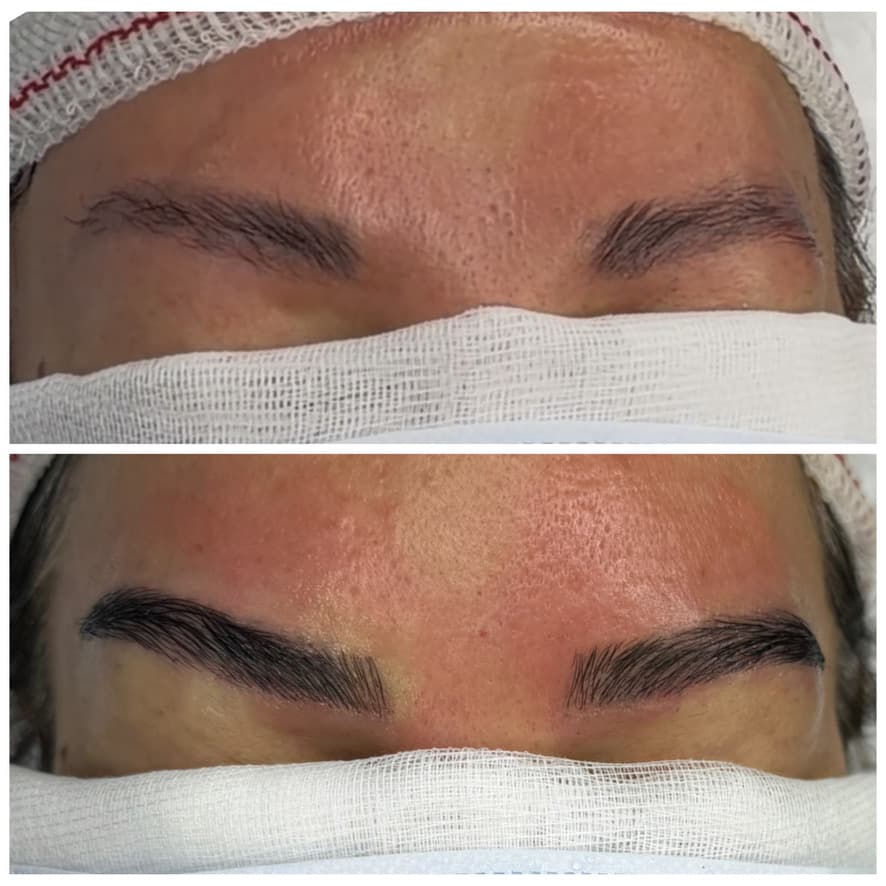 Injerto de cejas: antes y después