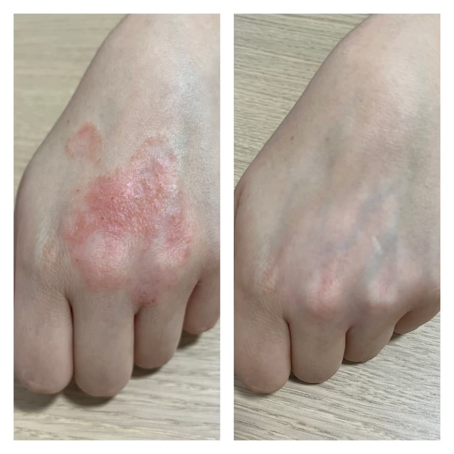 Tratamiento de dermatitis: antes y después