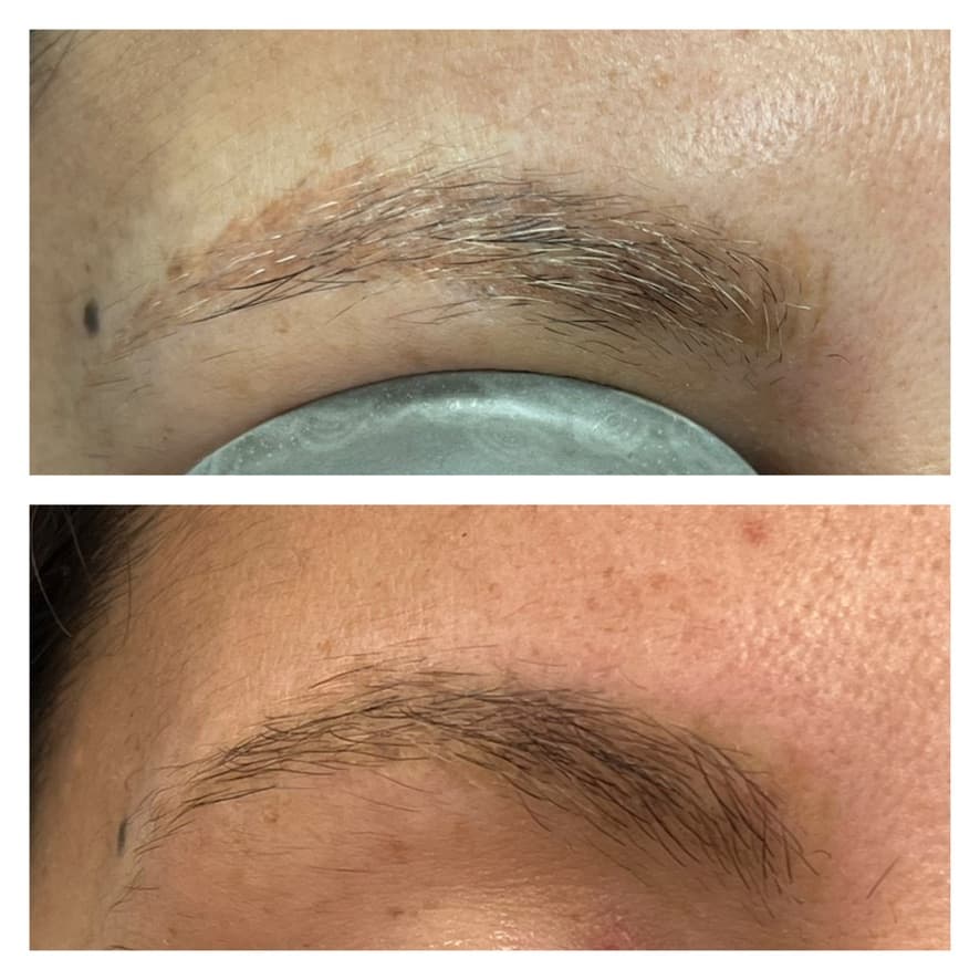 Retiro de microblading con láser: antes y después