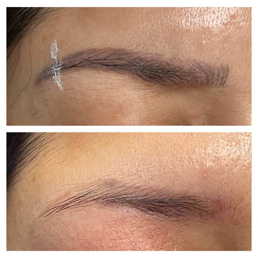 Retiro de microblading con láser: antes y después