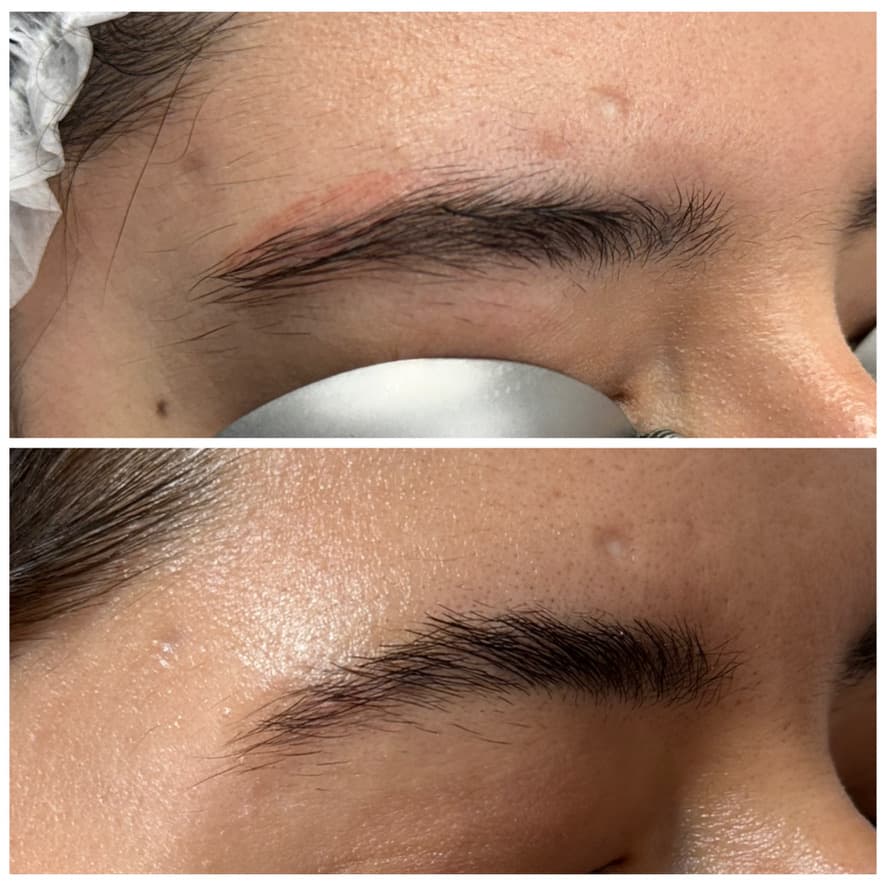 Retiro de microblading con láser: antes y después