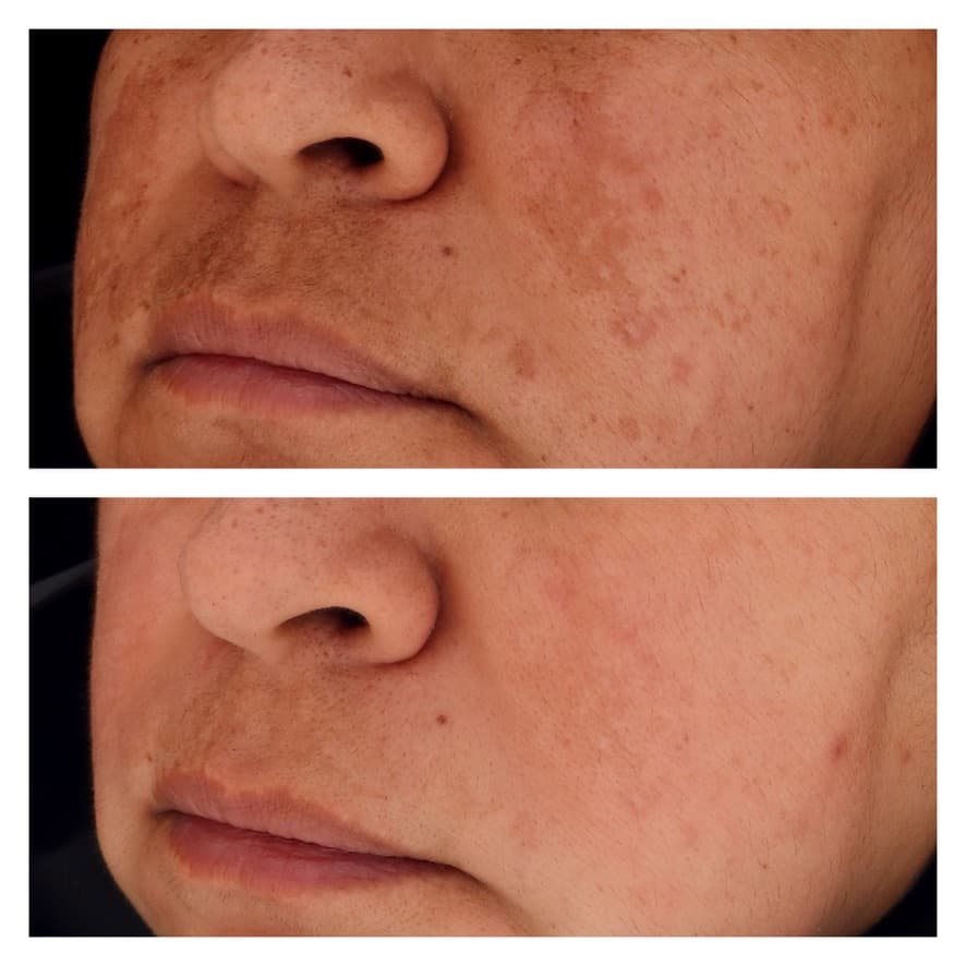 Tratamiento de melasma: antes y después