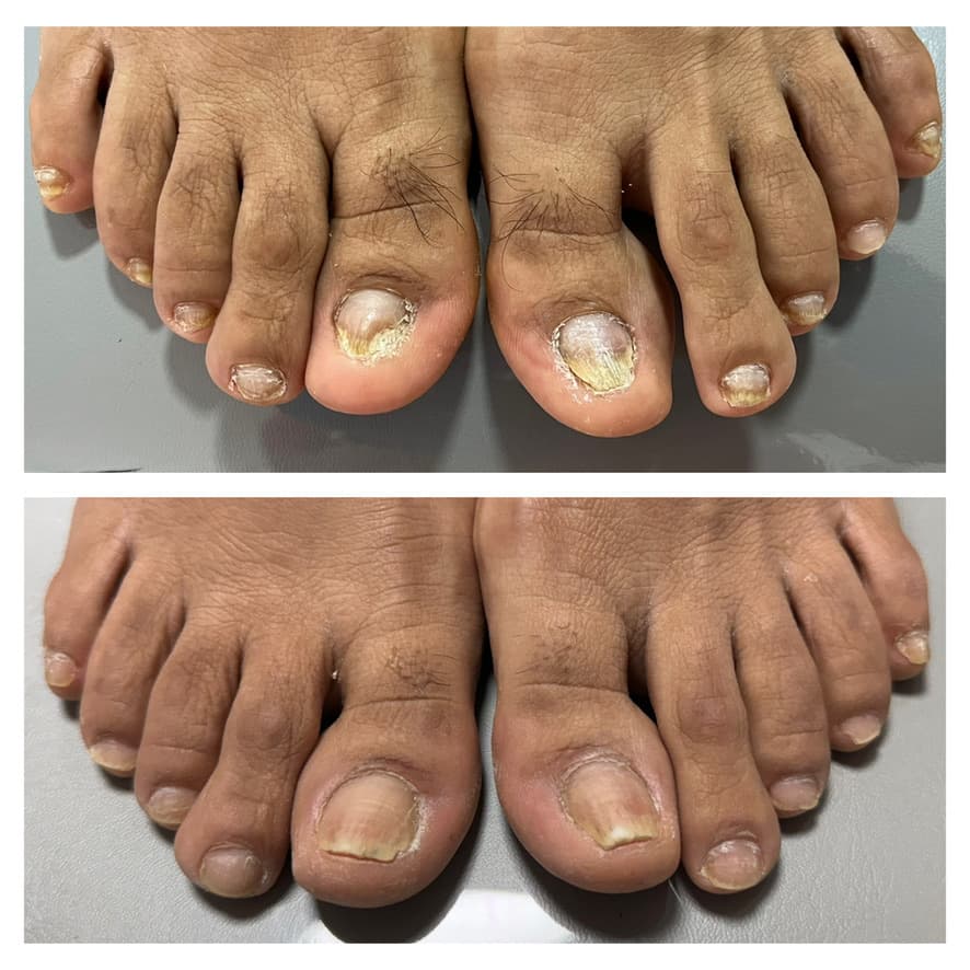 Tratamiento de hongos en las uñas: antes y después