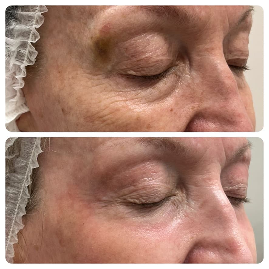 Peeling químico: antes y después