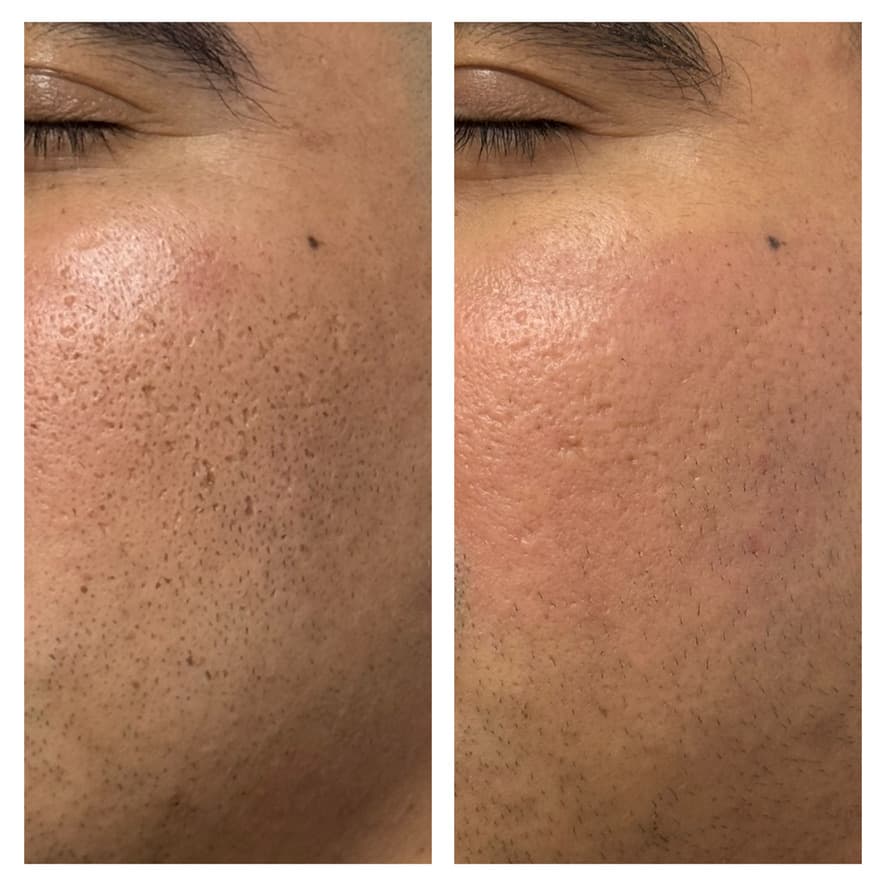 Peeling químico: antes y después
